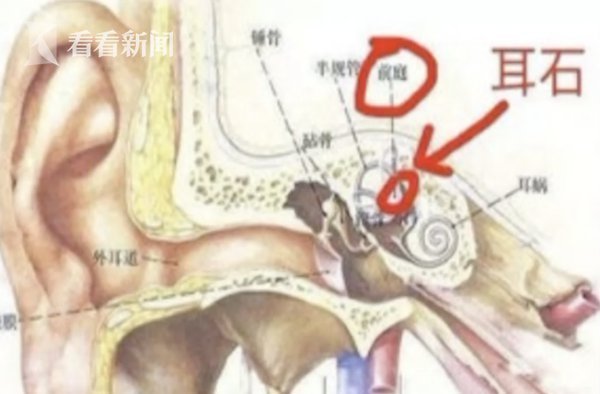 用筋膜枪放松肌肉竟把自己打晕，竟把耳石打下来了