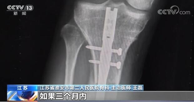 注意！断骨增高手术严禁用于美容项目 患者也追究其责任